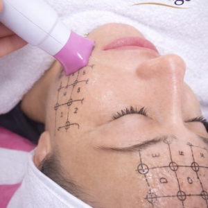Thermage FLX – Неинвазивен лифтинг и подмладяване на лице и тяло